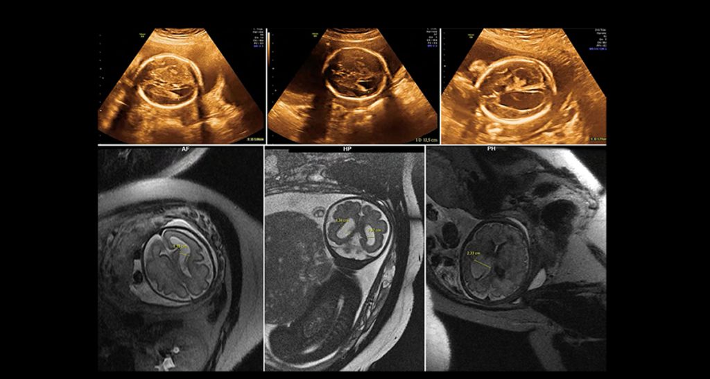 Risks and Complications of Amniocentesis