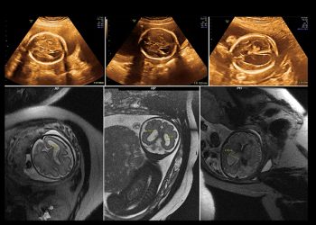 Risks and Complications of Amniocentesis