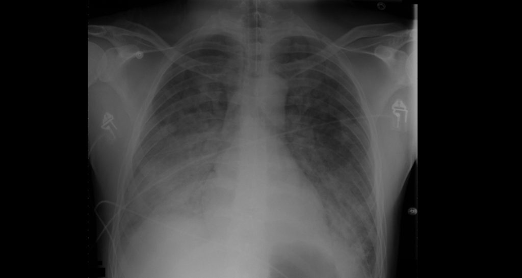 Symptoms and Early Warning Signs of ARDS