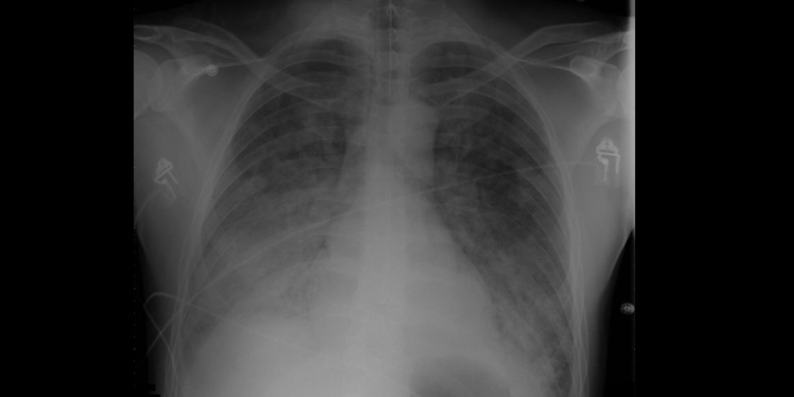 Symptoms and Early Warning Signs of ARDS