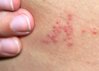 Symptoms and Reactions to Bedbug Bites