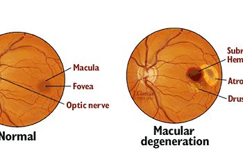 Symptoms and Stages of AMD