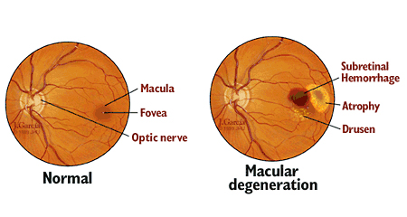 Symptoms and Stages of AMD