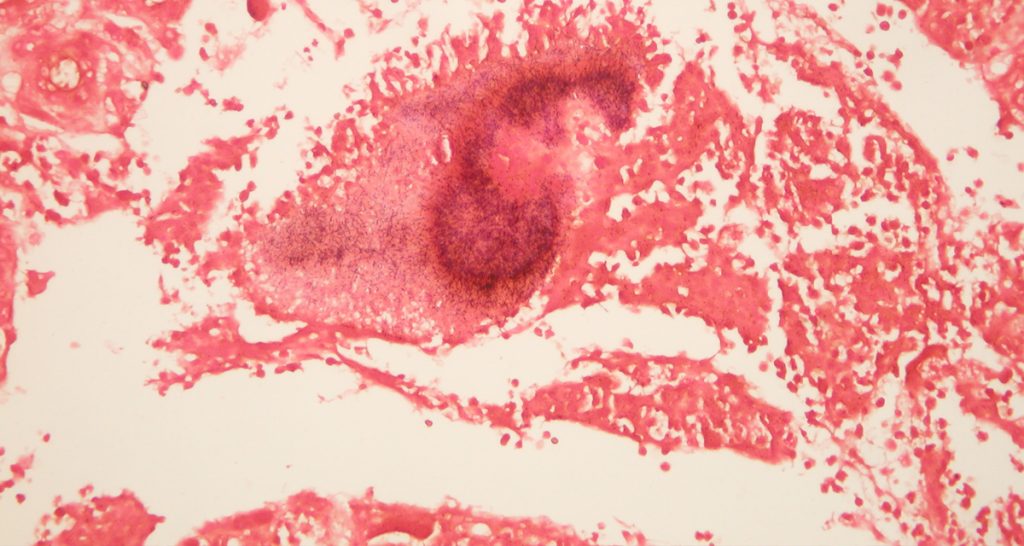 Symptoms and Types of Actinomycosis