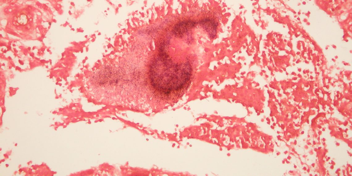 Symptoms and Types of Actinomycosis