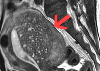 Symptoms and Warning Signs of Adenomyosis