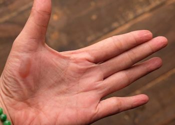 Close-up of a hand with a large blister on the palm