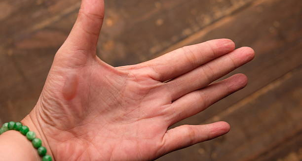 Close-up of a hand with a large blister on the palm