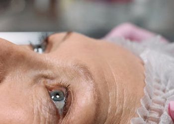 Adult woman with visible signs of cataracts in her eyes