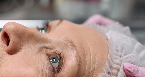 Adult woman with visible signs of cataracts in her eyes