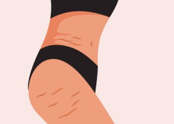 Illustration of a woman’s hip and thigh showing skin inflammation