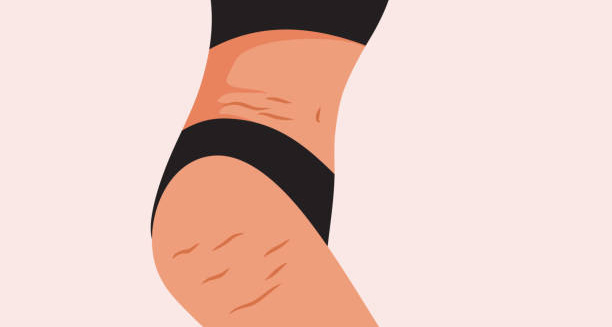 Illustration of a woman’s hip and thigh showing skin inflammation