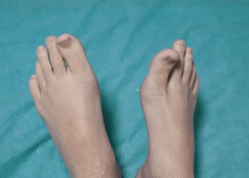 Deformed feet on a medical bed showing high arches and curled toes
