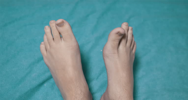 Deformed feet on a medical bed showing high arches and curled toes