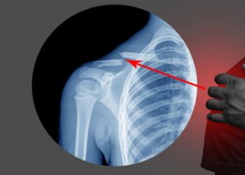 X-ray of a broken collarbone with red arrow highlighting the fracture area