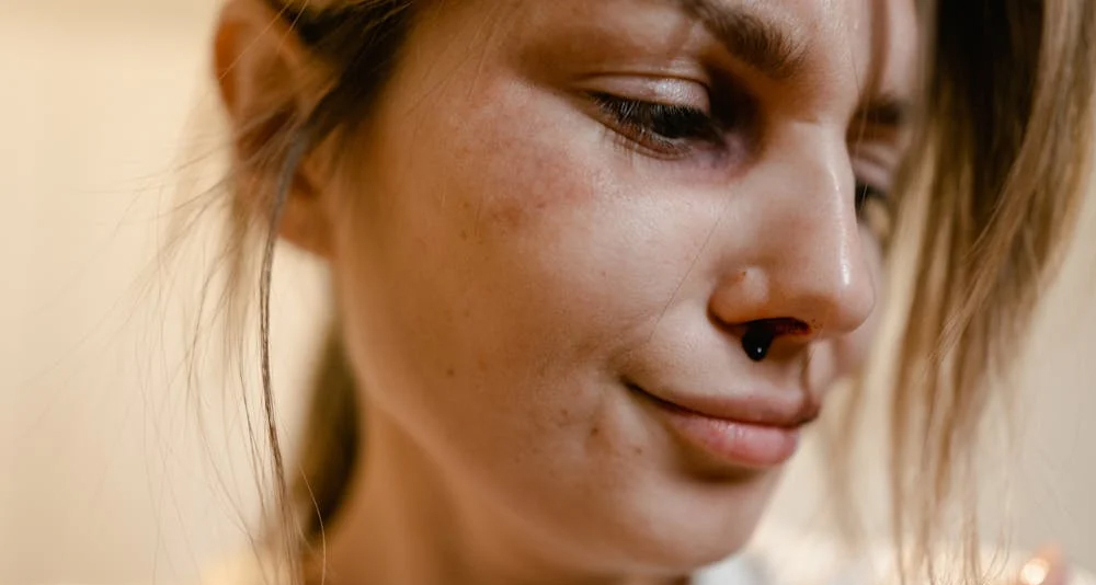 Woman with a bruised nose and nosebleed, showing symptoms of a broken nose