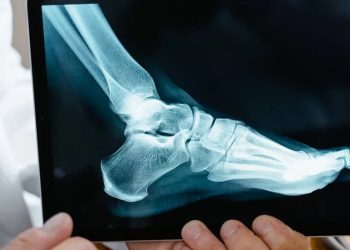 X-ray of foot showing fractured toe bones