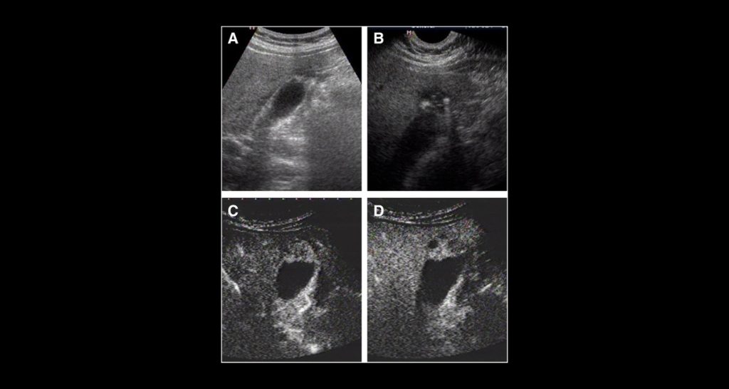 Treatment Options for Adenomyosis