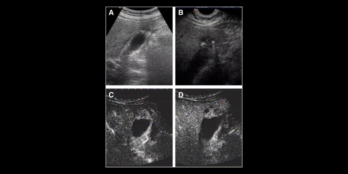 Treatment Options for Adenomyosis