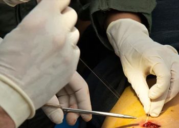Close-up of a medical procedure where a doctor is performing a minor surgical intervention to treat a bone cyst.