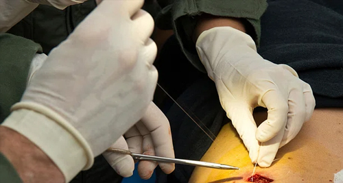 Close-up of a medical procedure where a doctor is performing a minor surgical intervention to treat a bone cyst.