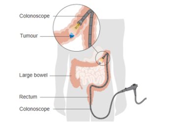 Diagram showing a colonoscope examining a tumour in the large bowel for bowel cancer treatment.