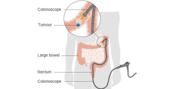 Diagram showing a colonoscope examining a tumour in the large bowel for bowel cancer treatment.