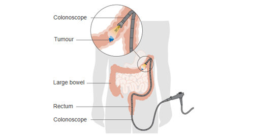 Diagram showing a colonoscope examining a tumour in the large bowel for bowel cancer treatment.