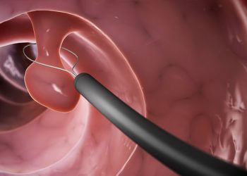 Endoscopic removal of a bowel polyp using a wire loop during colonoscopy