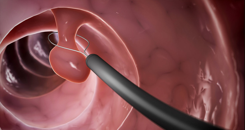 Endoscopic removal of a bowel polyp using a wire loop during colonoscopy