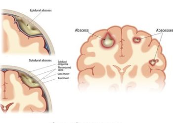 Medical diagram showing locations of epidural, subdural, and cerebral brain abscesses with treatment focus