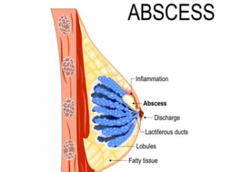 Medical diagram showing treatment zones of a breast abscess