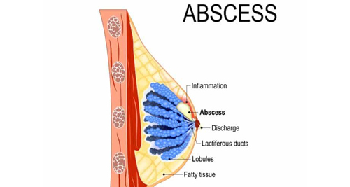 Medical diagram showing treatment zones of a breast abscess