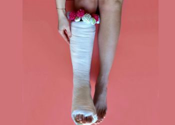 Treatment Options for Broken Ankle