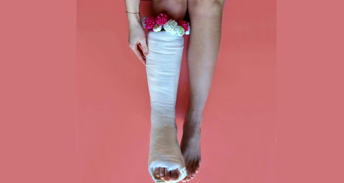 Treatment Options for Broken Ankle