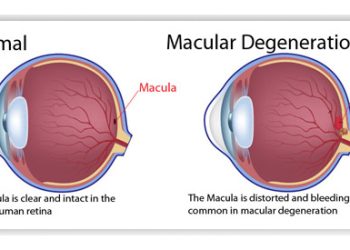 Treatment and Management of AMD
