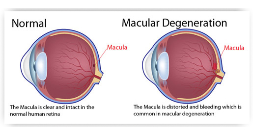 Treatment and Management of AMD