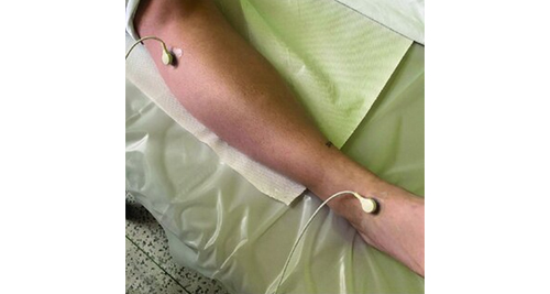 Treatment and Management of Atherosclerosis