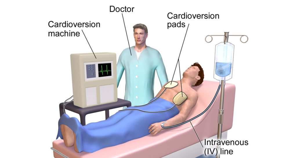 Treatment and Management of Atrial Fibrillation