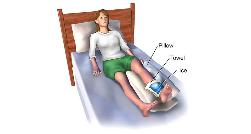 Woman using ice, towel, and pillow to relieve swelling and manage symptoms of a Baker’s cyst in the leg.
