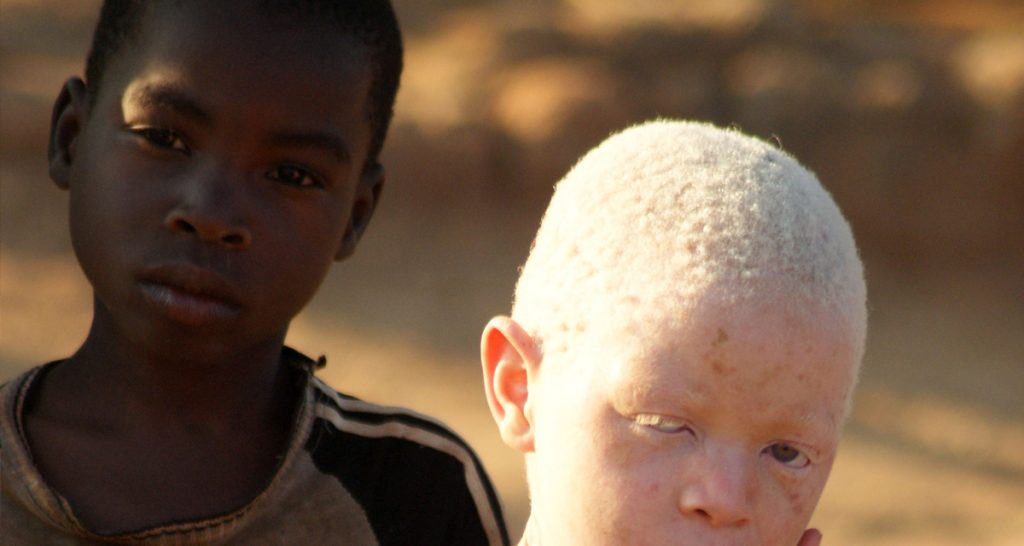 Treatment for Albinism