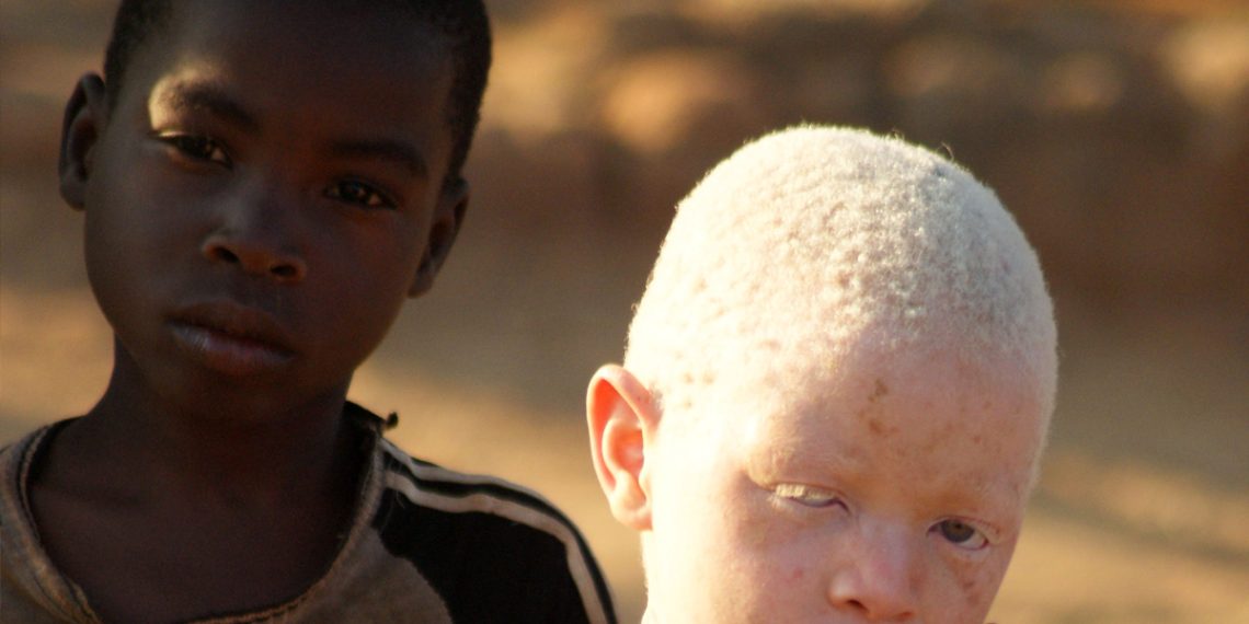 Treatment for Albinism