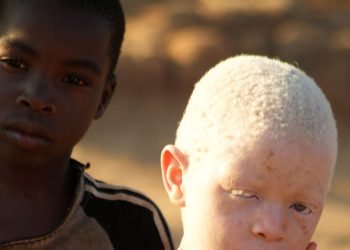 Treatment for Albinism