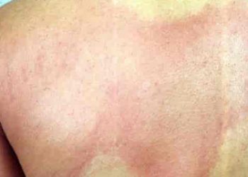 Treatment for Anaphylaxis