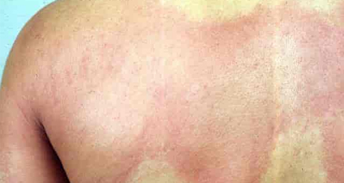 Treatment for Anaphylaxis