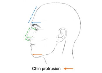 Side profile diagram showing chin and facial muscle alignment used in evaluating Bell’s palsy and facial asymmetry during treatment planning.