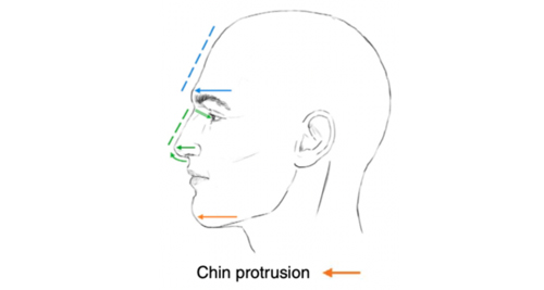 Side profile diagram showing chin and facial muscle alignment used in evaluating Bell’s palsy and facial asymmetry during treatment planning.