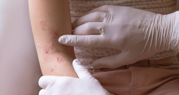 Doctor examining a patient's arm with blistering skin condition
