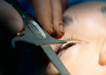 Child undergoing cataract eye surgery