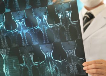 Doctor examining cervical spine MRI scans for spondylosis treatment